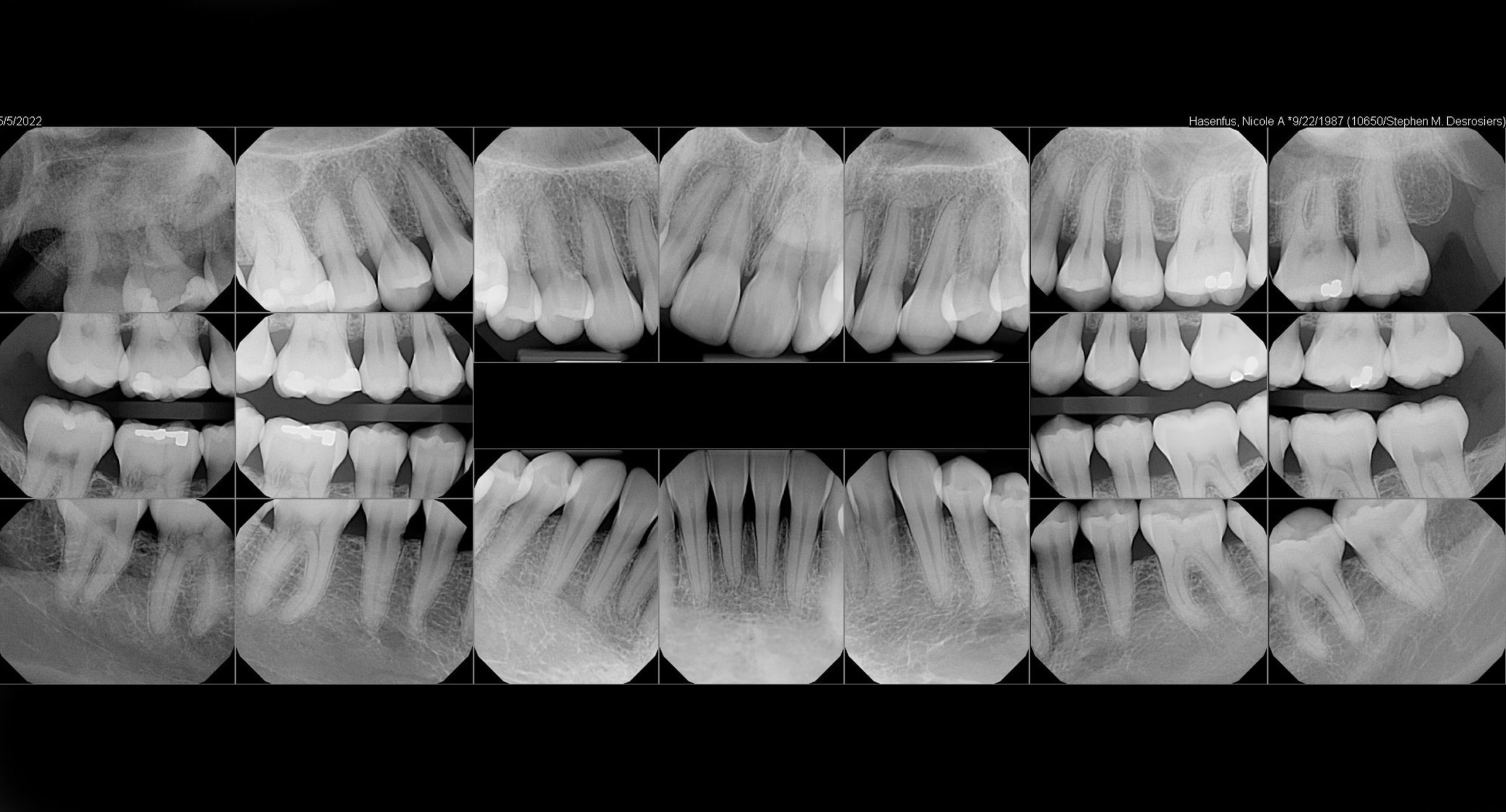 Blue X Dental X Ray At Lauren Harris Blog